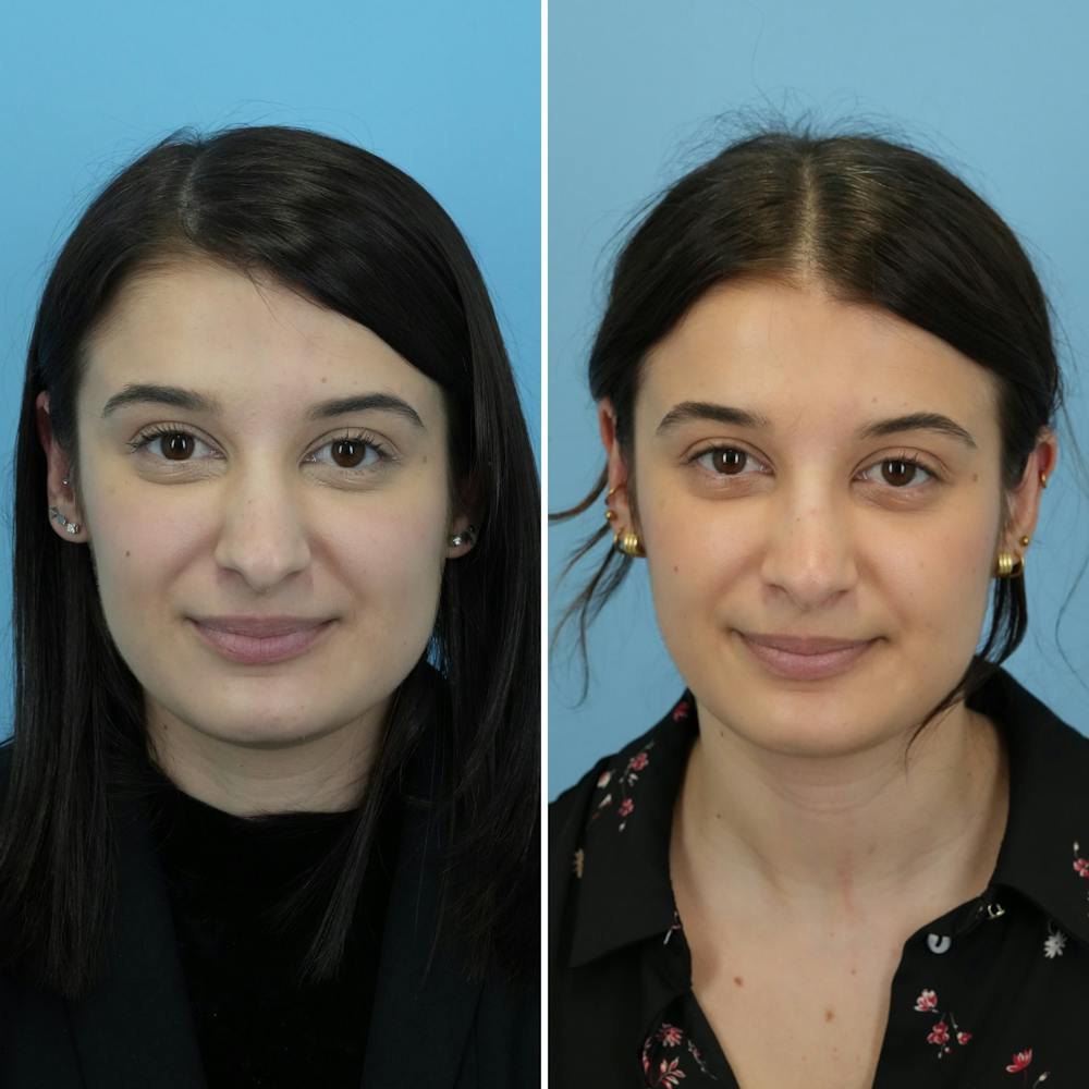 Rhinoplasty Before & After Gallery - Patient 312627 - Image 4