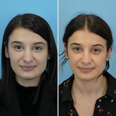 Rhinoplasty Before & After Gallery - Patient 312627 - Image 4