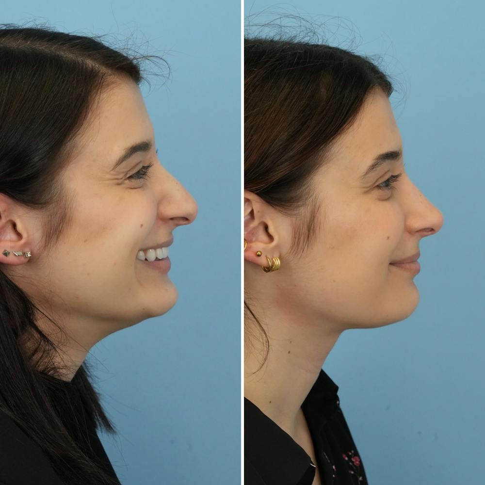 Rhinoplasty Before & After Gallery - Patient 312627 - Image 2