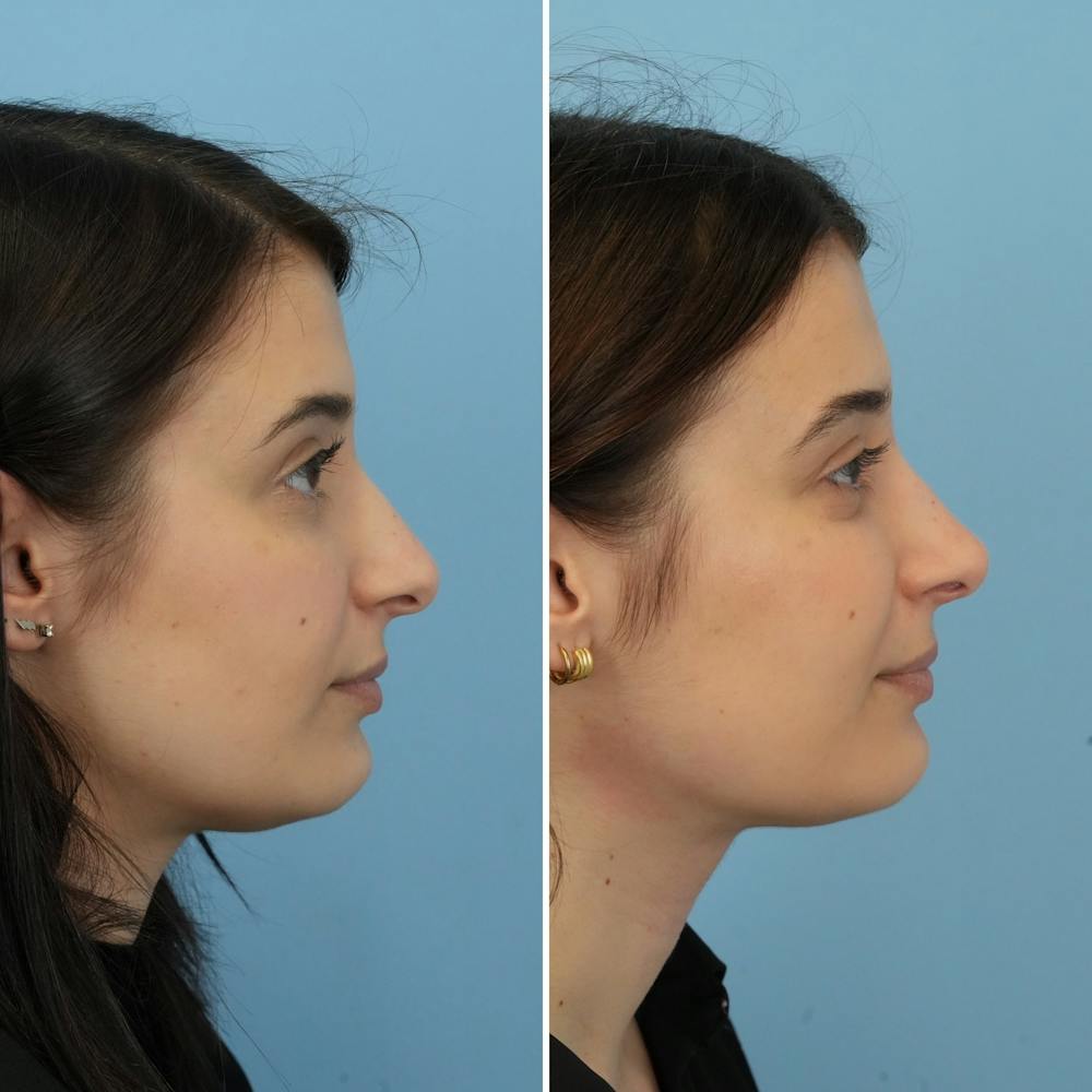 Rhinoplasty Before & After Gallery - Patient 312627 - Image 1