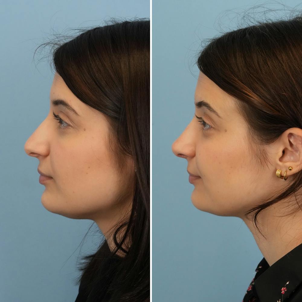 Rhinoplasty Before & After Gallery - Patient 312627 - Image 7