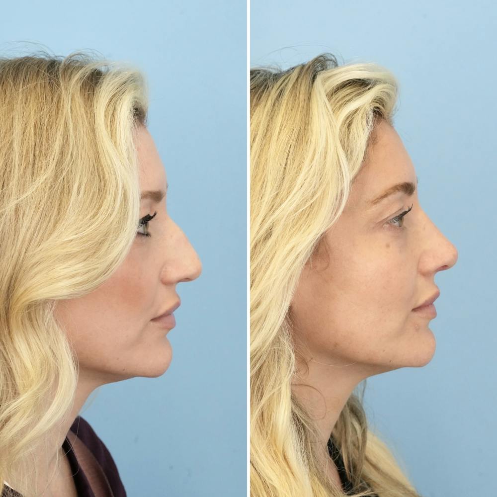 Rhinoplasty Before & After Gallery - Patient 406848 - Image 1