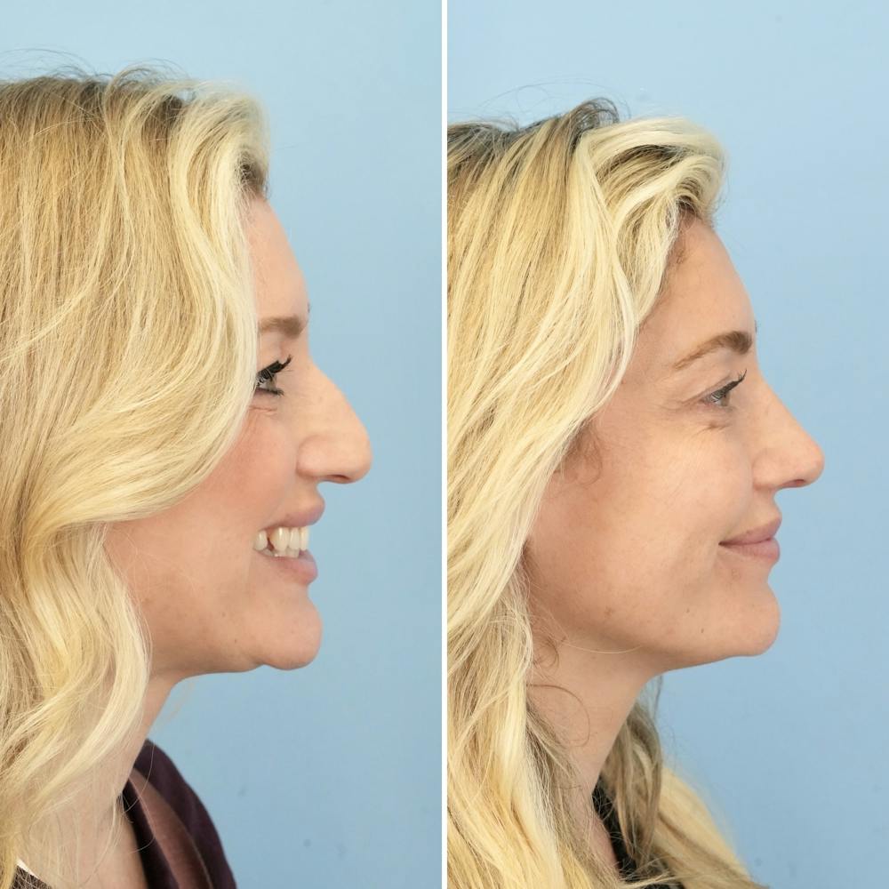 Rhinoplasty Before & After Gallery - Patient 406848 - Image 2