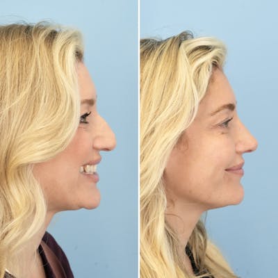 Rhinoplasty Before & After Gallery - Patient 406848 - Image 2