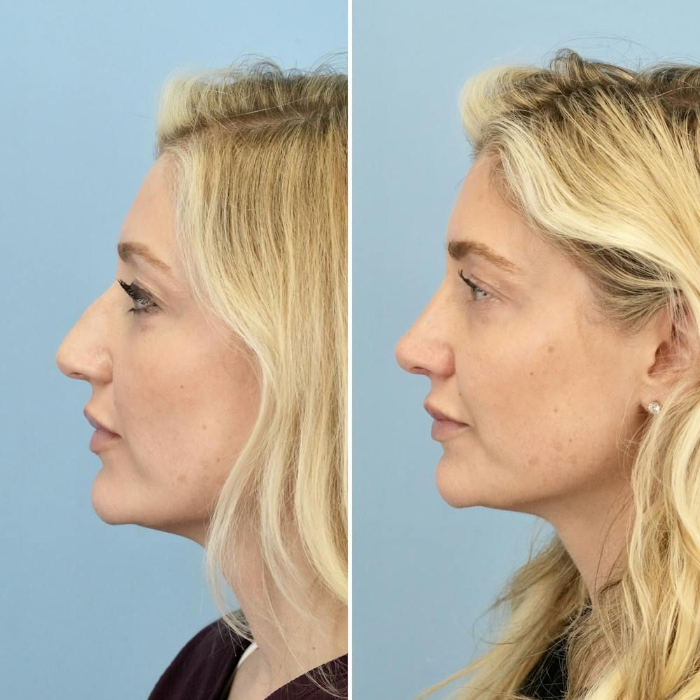 Rhinoplasty Before & After Gallery - Patient 406848 - Image 6