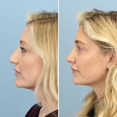 Rhinoplasty Before & After Gallery - Patient 406848 - Image 6