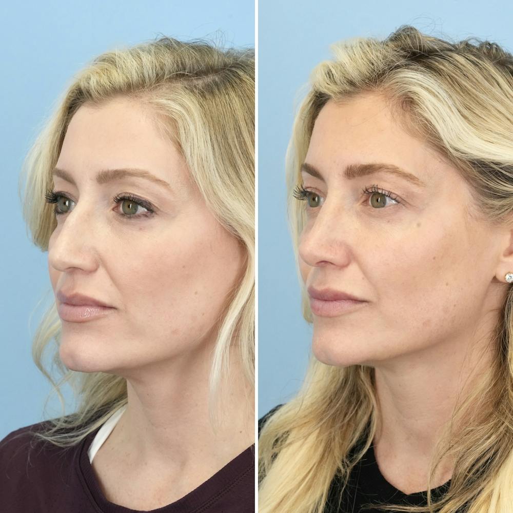 Rhinoplasty Before & After Gallery - Patient 406848 - Image 4