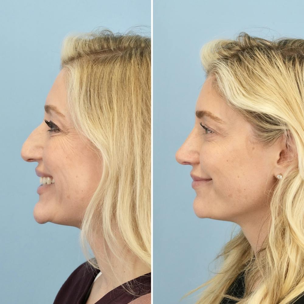 Rhinoplasty Before & After Gallery - Patient 406848 - Image 5