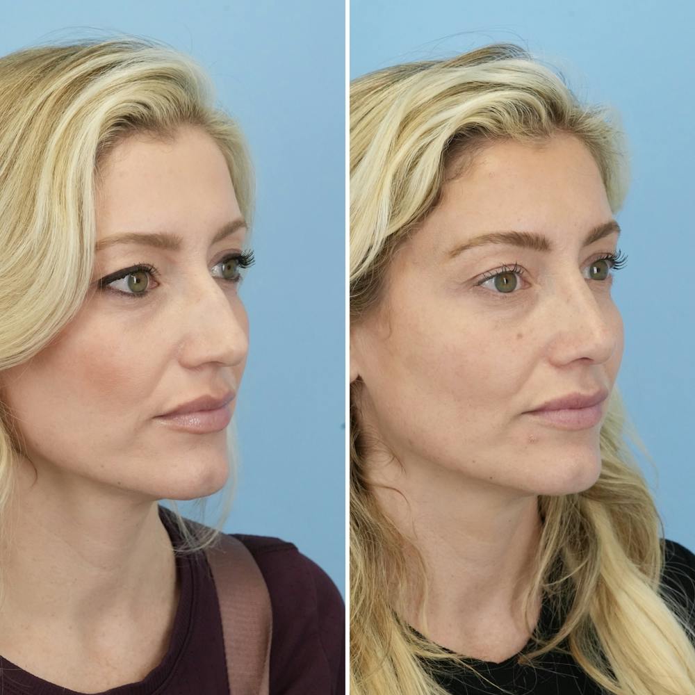 Rhinoplasty Before & After Gallery - Patient 406848 - Image 3