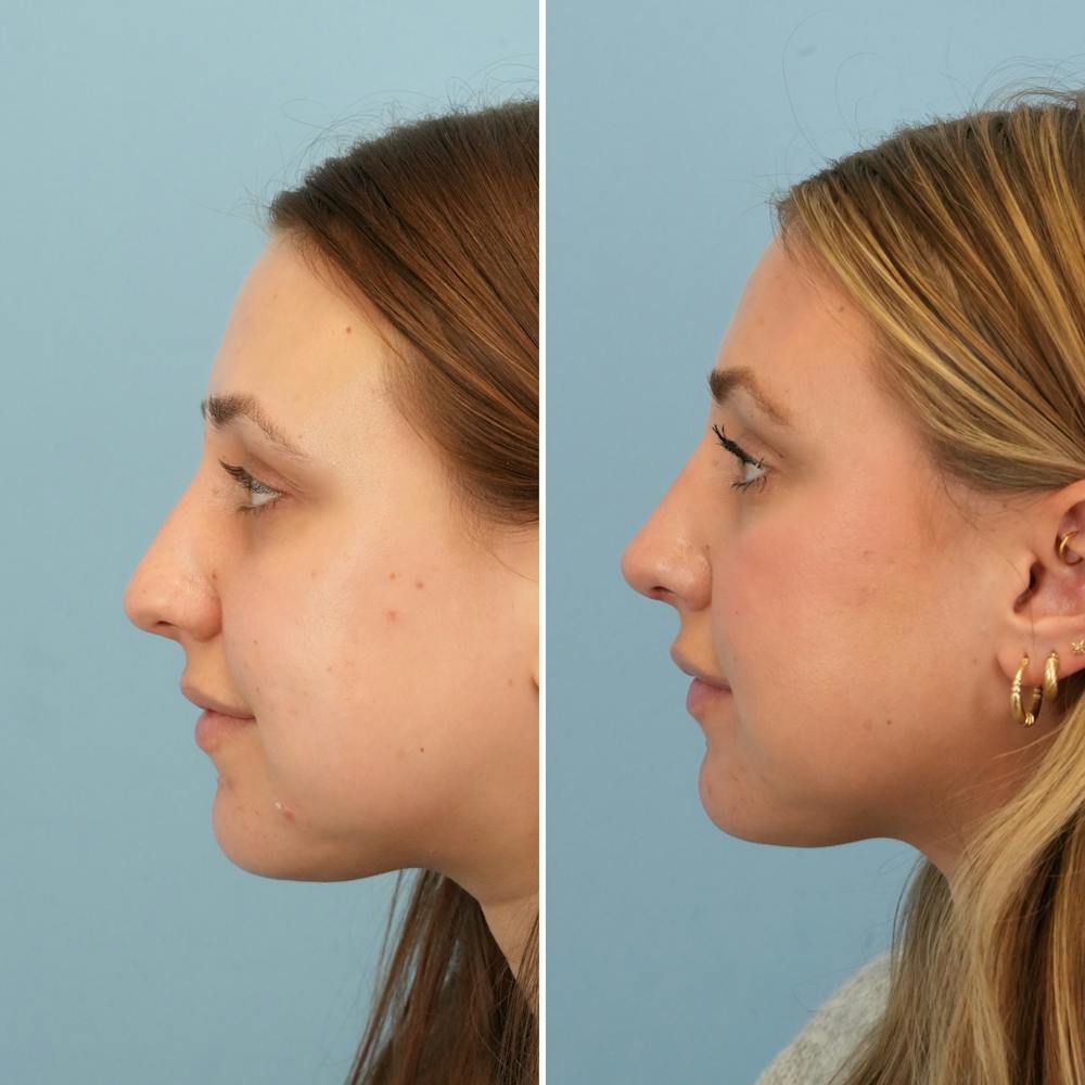 Rhinoplasty Before & After Gallery - Patient 160230 - Image 7