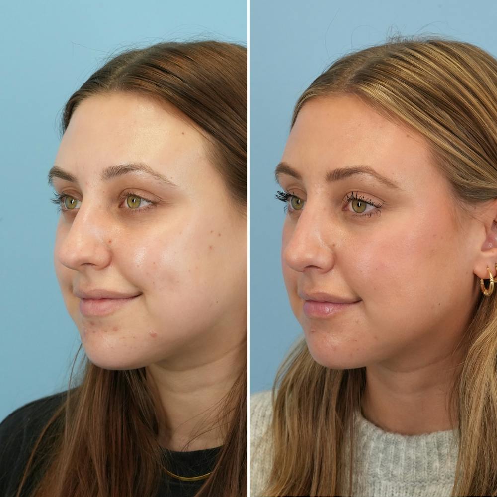 Rhinoplasty Before & After Gallery - Patient 160230 - Image 5