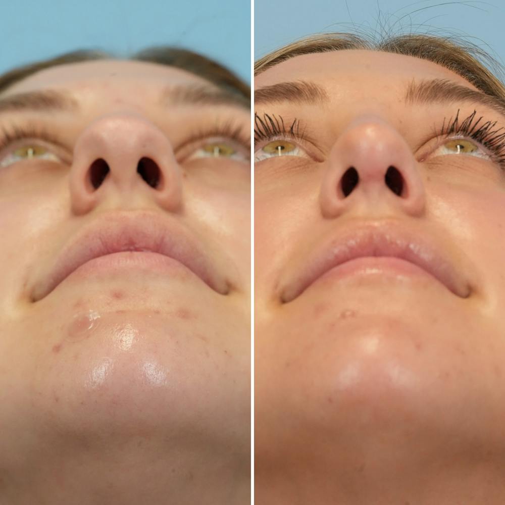 Rhinoplasty Before & After Gallery - Patient 160230 - Image 4