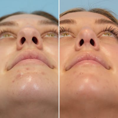 Rhinoplasty Before & After Gallery - Patient 160230 - Image 4