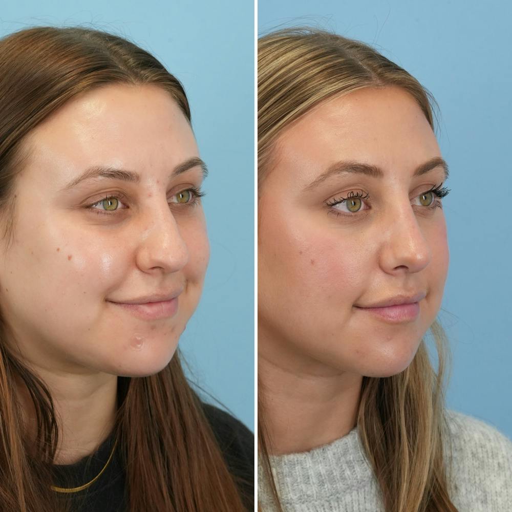 Rhinoplasty Before & After Gallery - Patient 160230 - Image 3