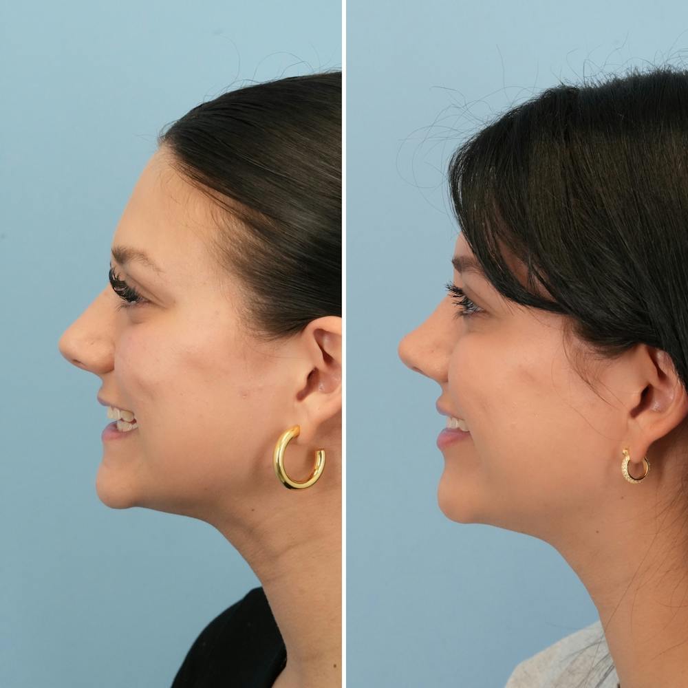 Rhinoplasty Before & After Gallery - Patient 306921 - Image 6