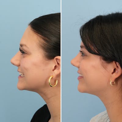 Rhinoplasty Before & After Gallery - Patient 306921 - Image 6