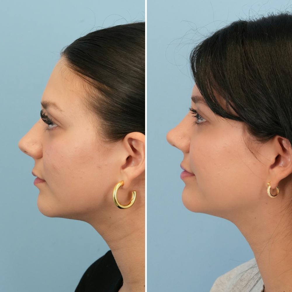 Rhinoplasty Before & After Gallery - Patient 306921 - Image 7