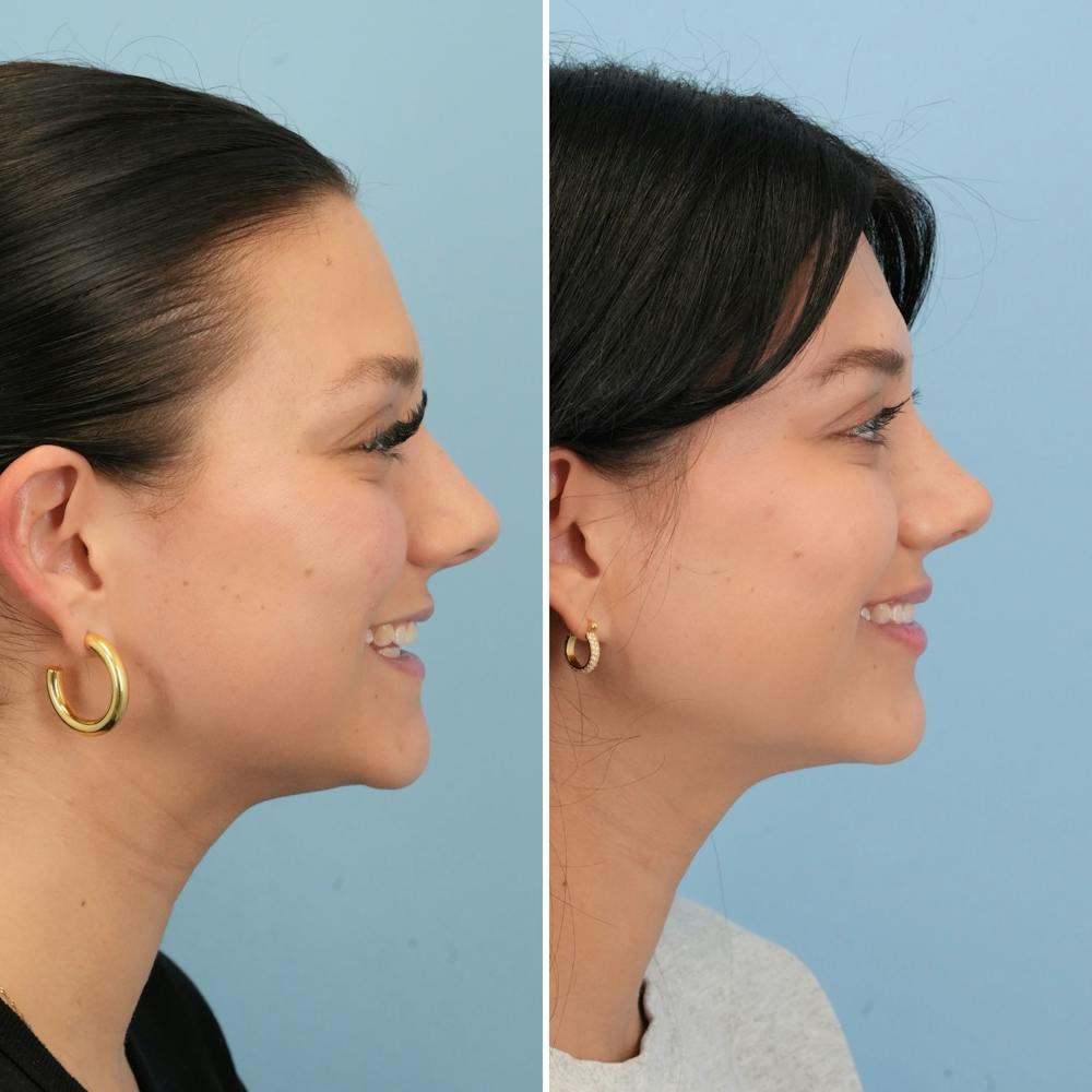 Rhinoplasty Before & After Gallery - Patient 306921 - Image 2