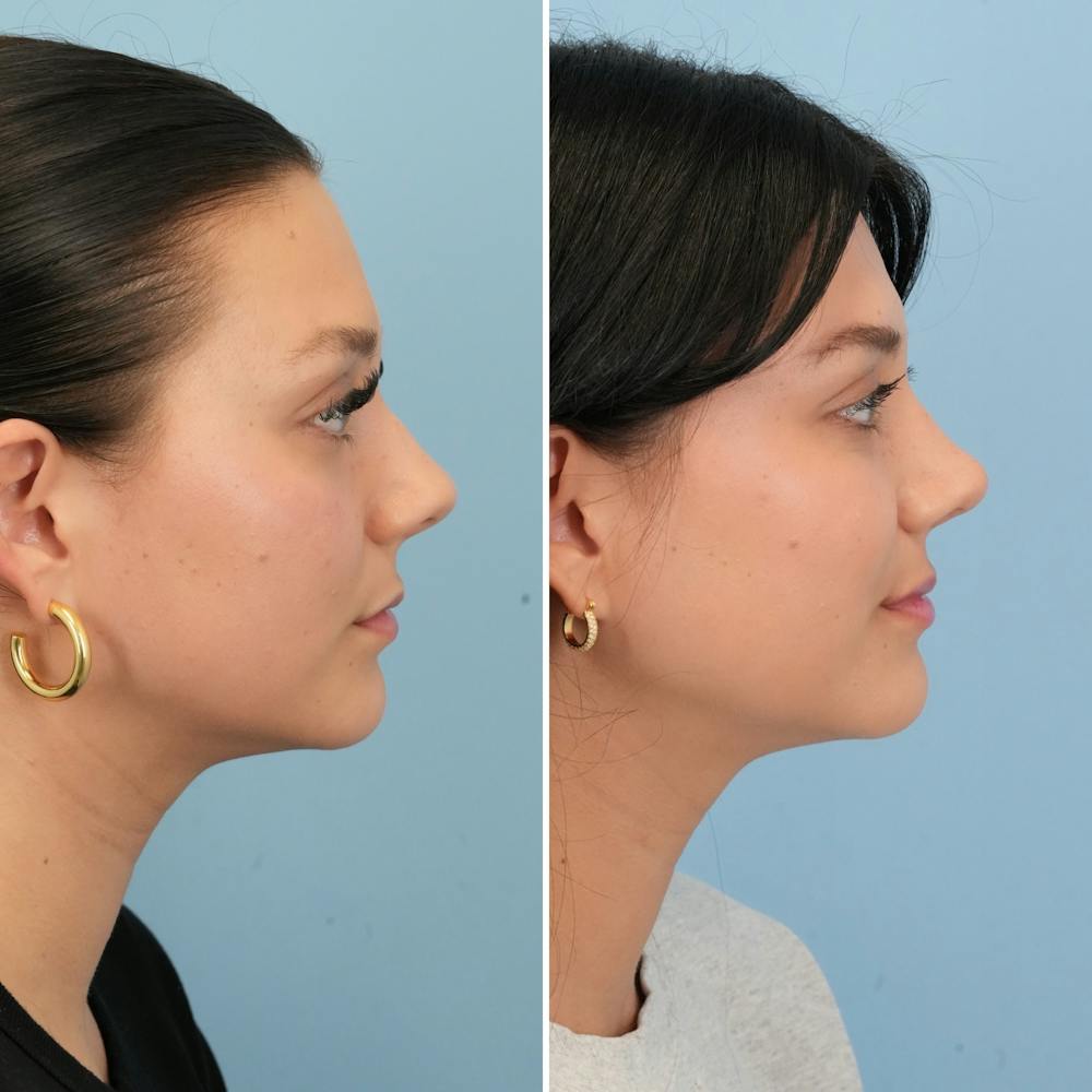 Rhinoplasty Before & After Gallery - Patient 306921 - Image 1