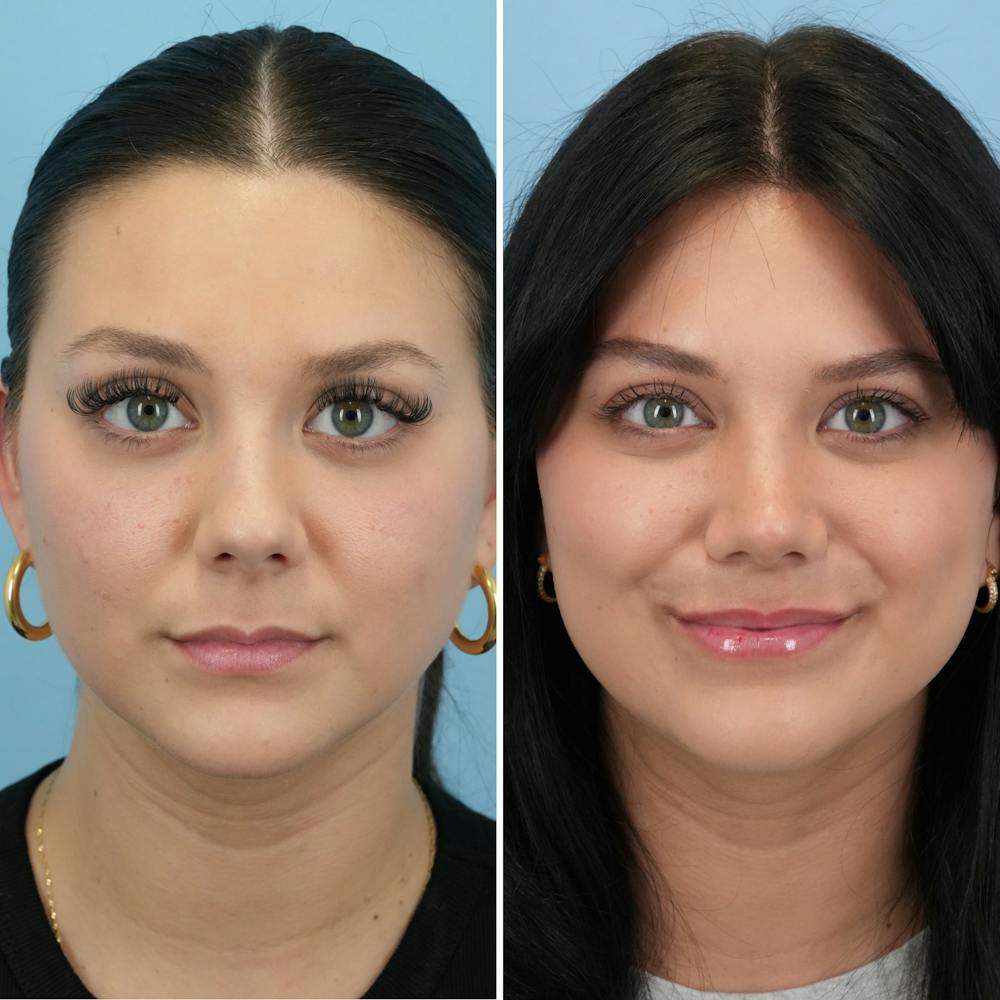 Rhinoplasty Before & After Gallery - Patient 306921 - Image 4