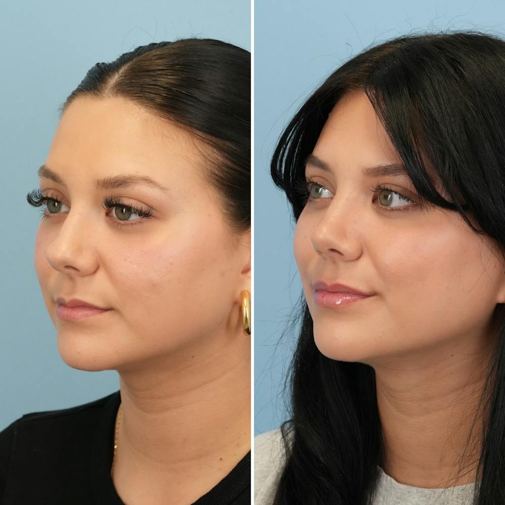 Rhinoplasty Before & After Gallery - Patient 306921 - Image 5