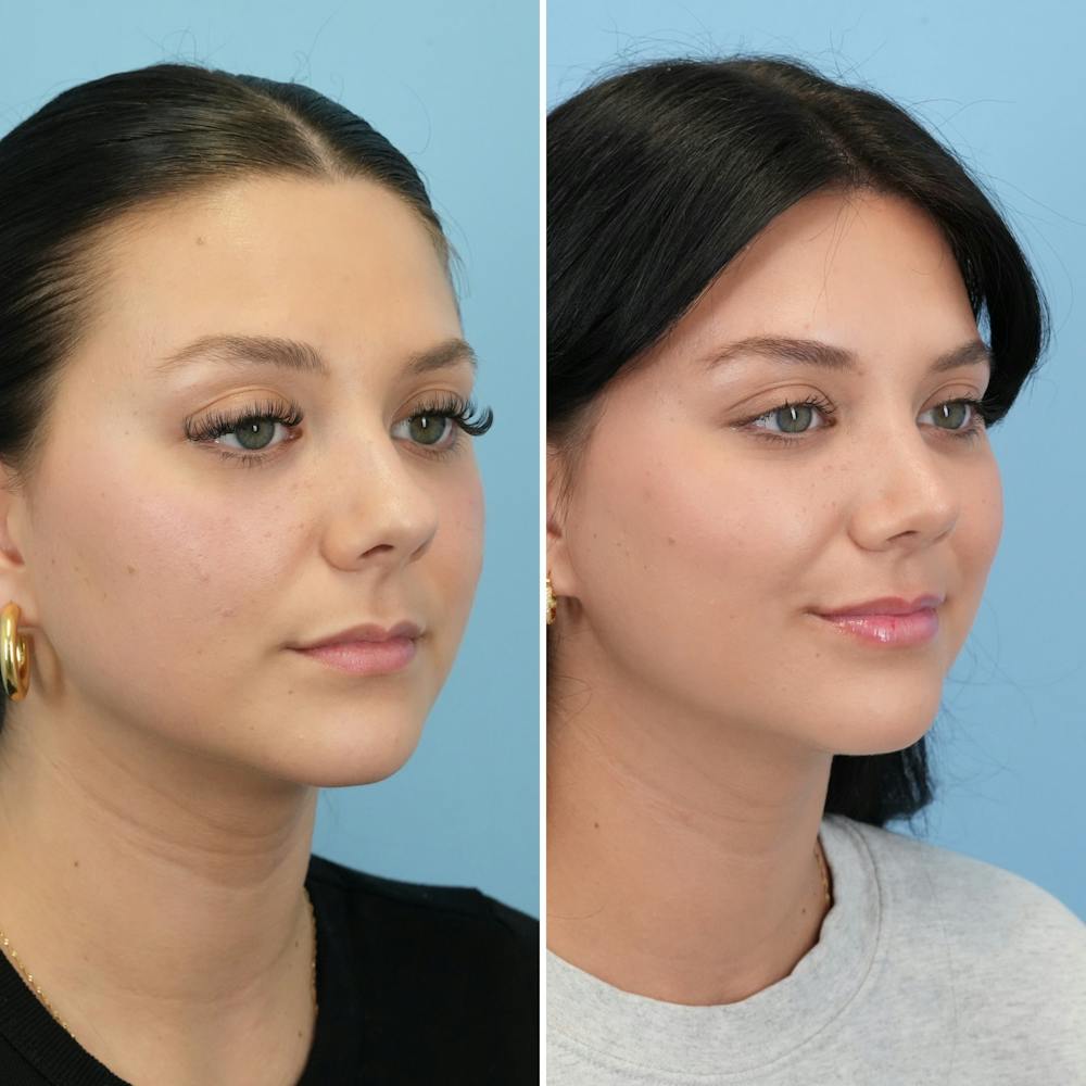 Rhinoplasty Before & After Gallery - Patient 306921 - Image 3