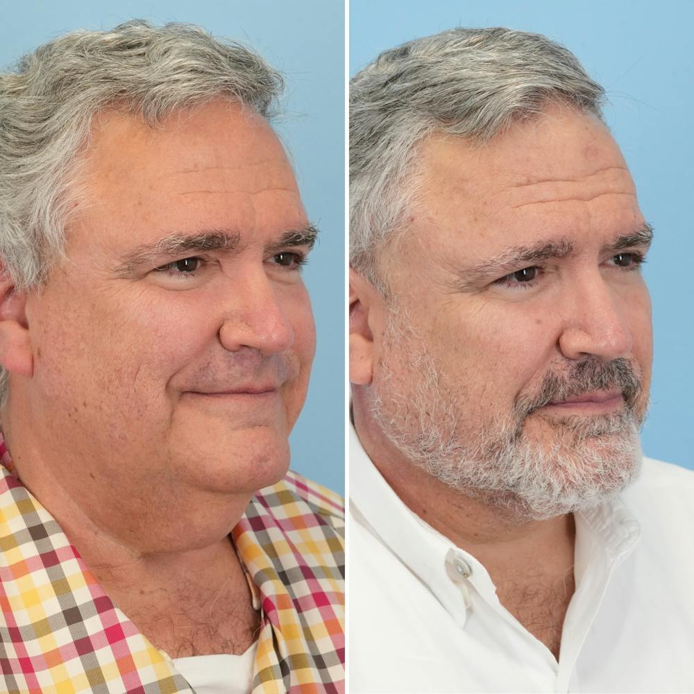 Facelift Before & After Gallery - Patient 155010 - Image 2