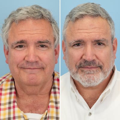 Facelift Before & After Gallery - Patient 155010 - Image 1