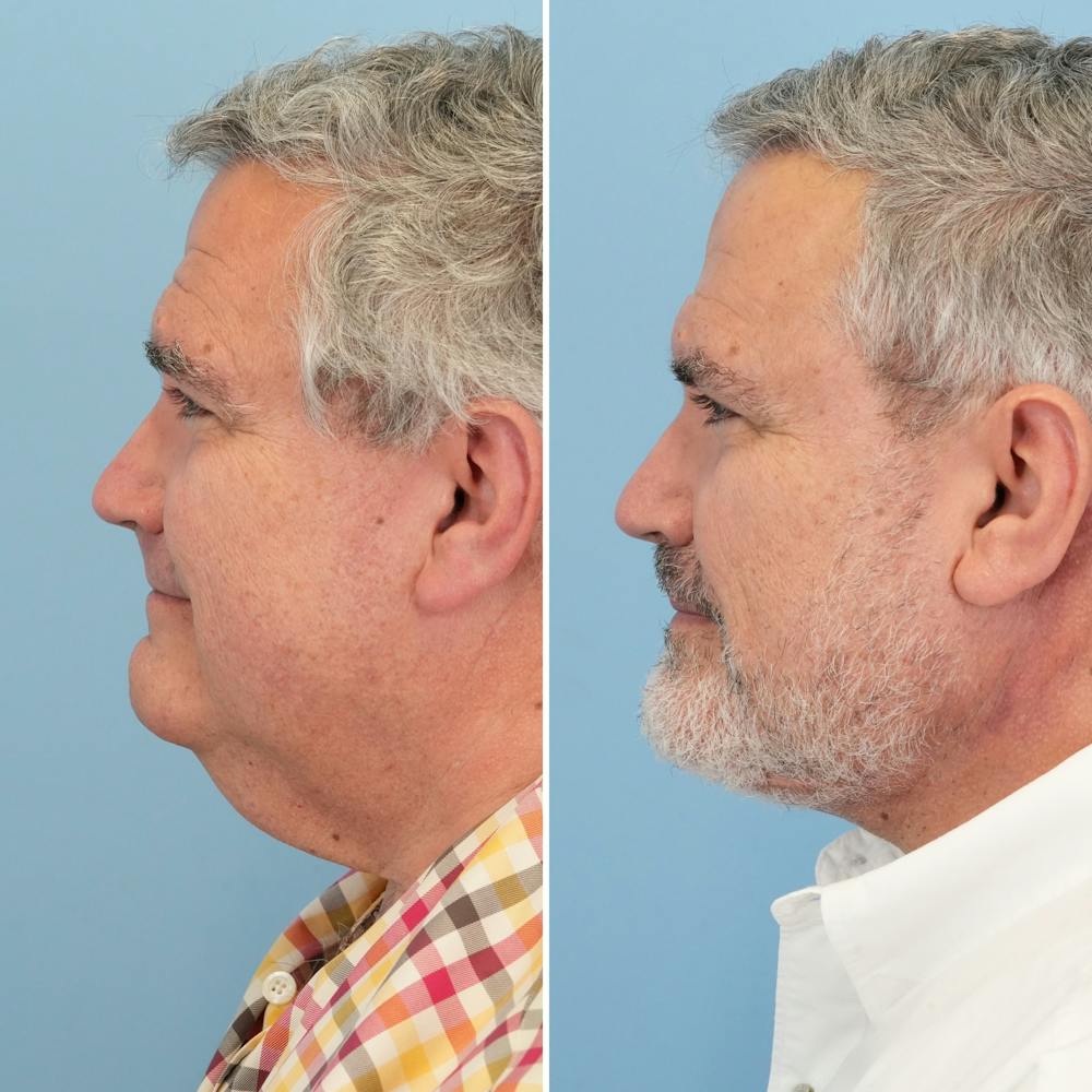 Facelift Before & After Gallery - Patient 155010 - Image 5
