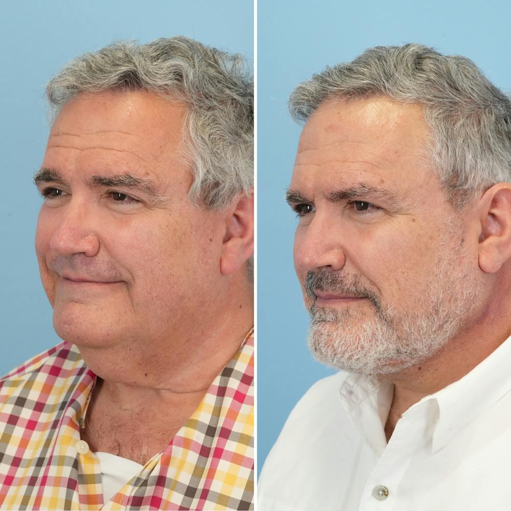 Facelift Before & After Gallery - Patient 155010 - Image 4