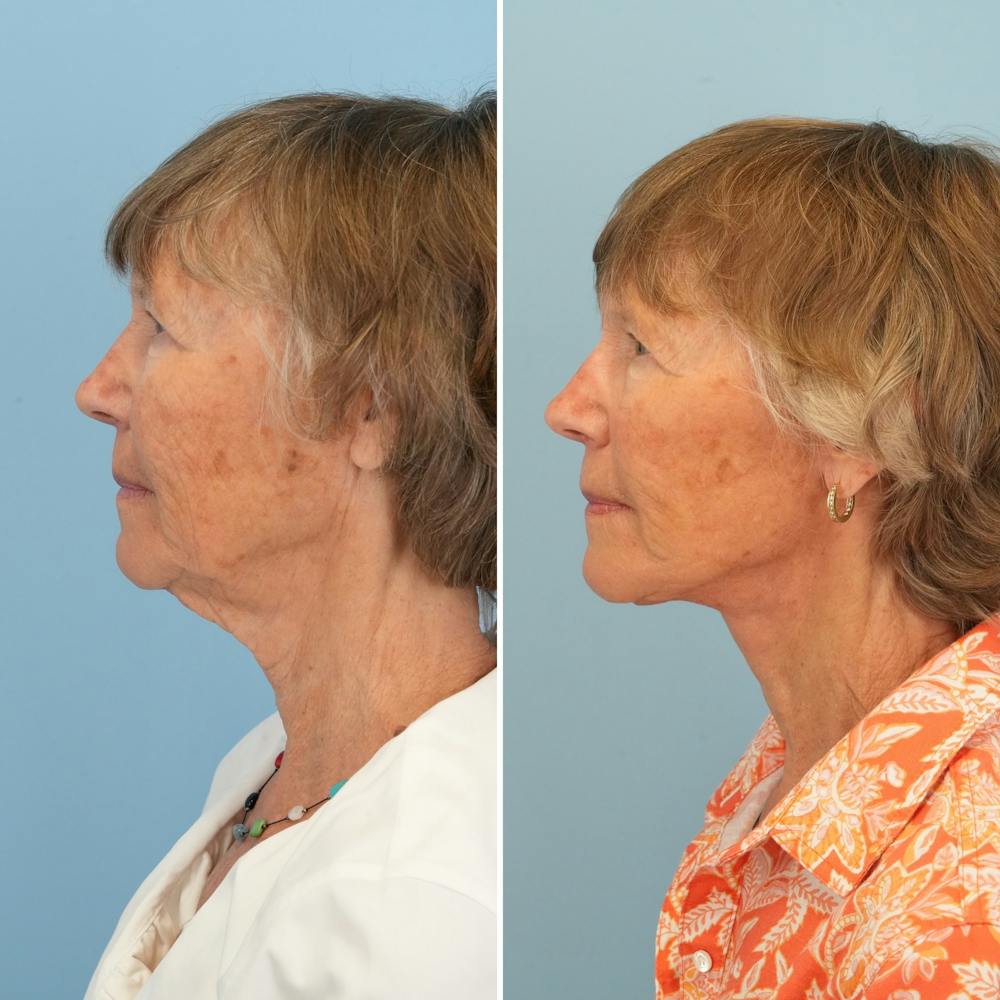 Facelift Before & After Gallery - Patient 211521 - Image 5