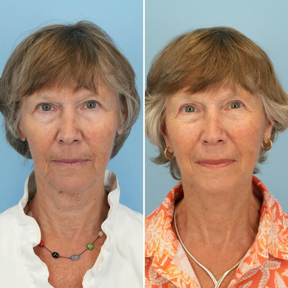 Facelift Before & After Gallery - Patient 211521 - Image 1