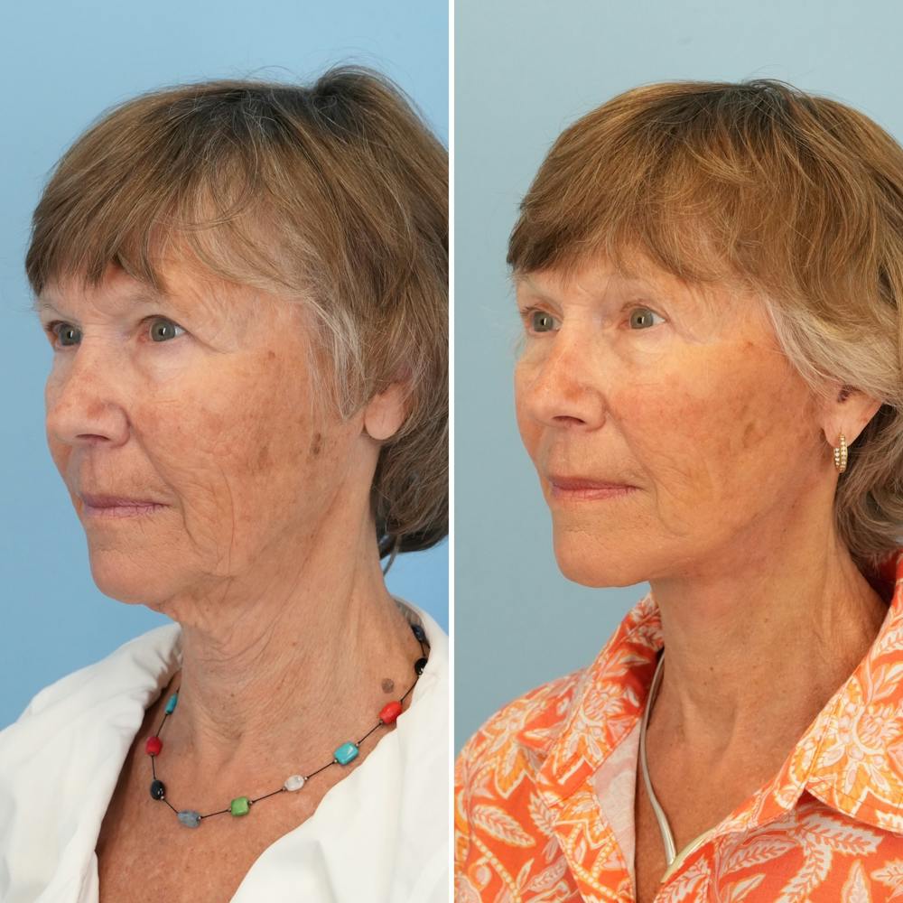 Facelift Before & After Gallery - Patient 211521 - Image 4