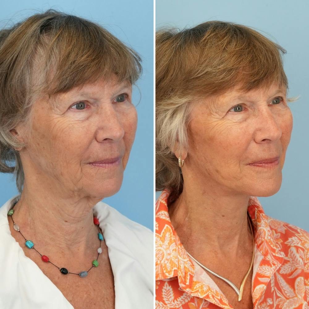 Facelift Before & After Gallery - Patient 211521 - Image 2