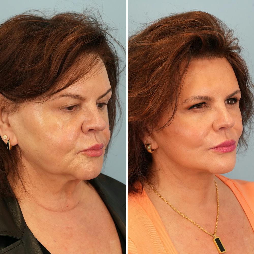 Facelift Before & After Gallery - Patient 393618 - Image 2