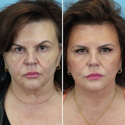 Facelift Before & After Gallery - Patient 393618 - Image 1