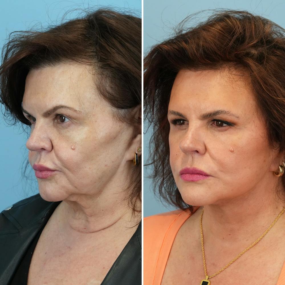 Facelift Before & After Gallery - Patient 393618 - Image 4