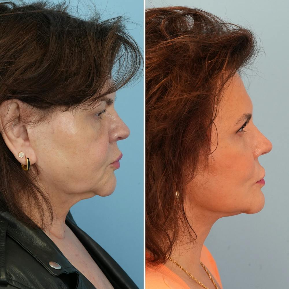 Facelift Before & After Gallery - Patient 393618 - Image 3