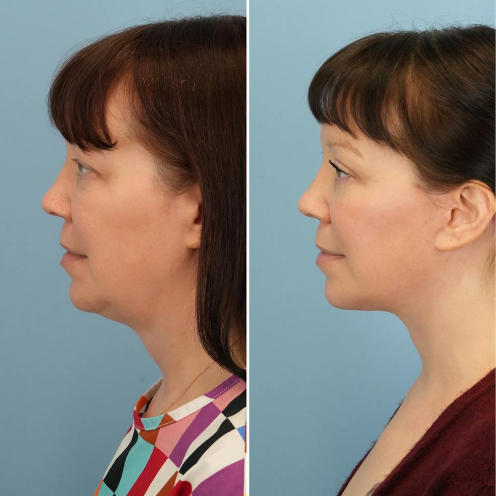 Facelift Before & After Gallery - Patient 176884076 - Image 3