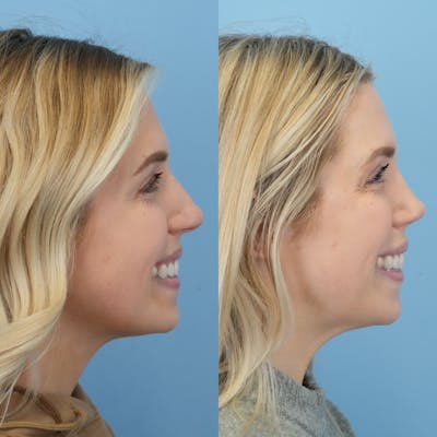 Rhinoplasty Before & After Gallery - Patient 178858 - Image 4