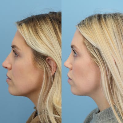 Rhinoplasty Before & After Gallery - Patient 178858 - Image 6