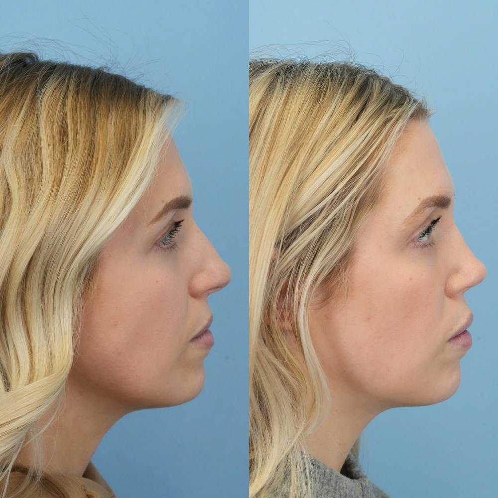 Rhinoplasty Before & After Gallery - Patient 178858 - Image 3
