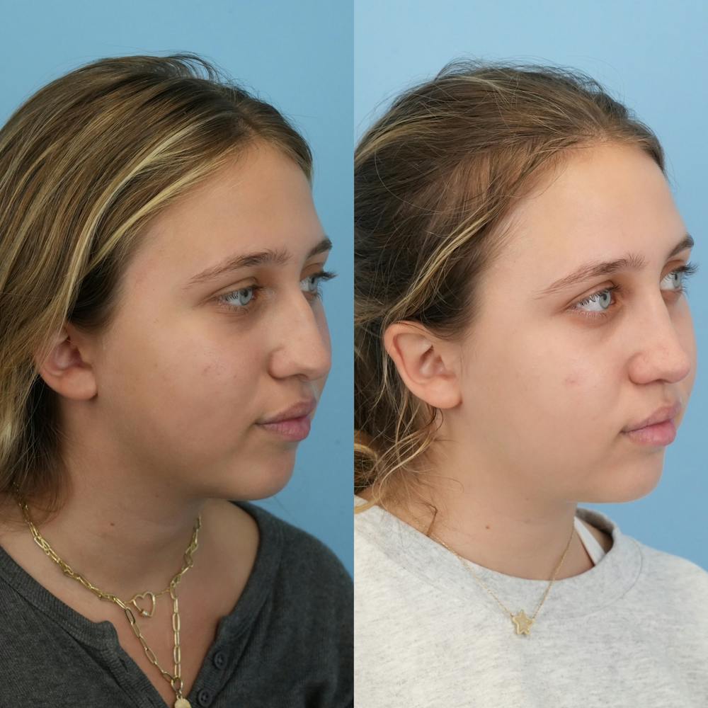 Rhinoplasty Before & After Gallery - Patient 287090 - Image 2