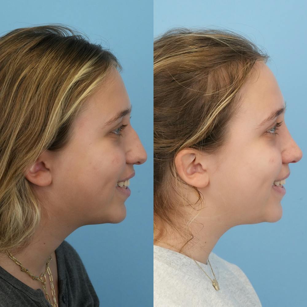 Rhinoplasty Before & After Gallery - Patient 287090 - Image 4