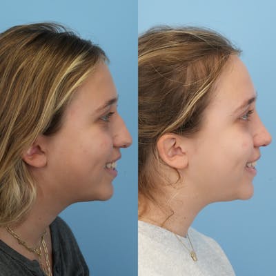 Rhinoplasty Before & After Gallery - Patient 287090 - Image 4