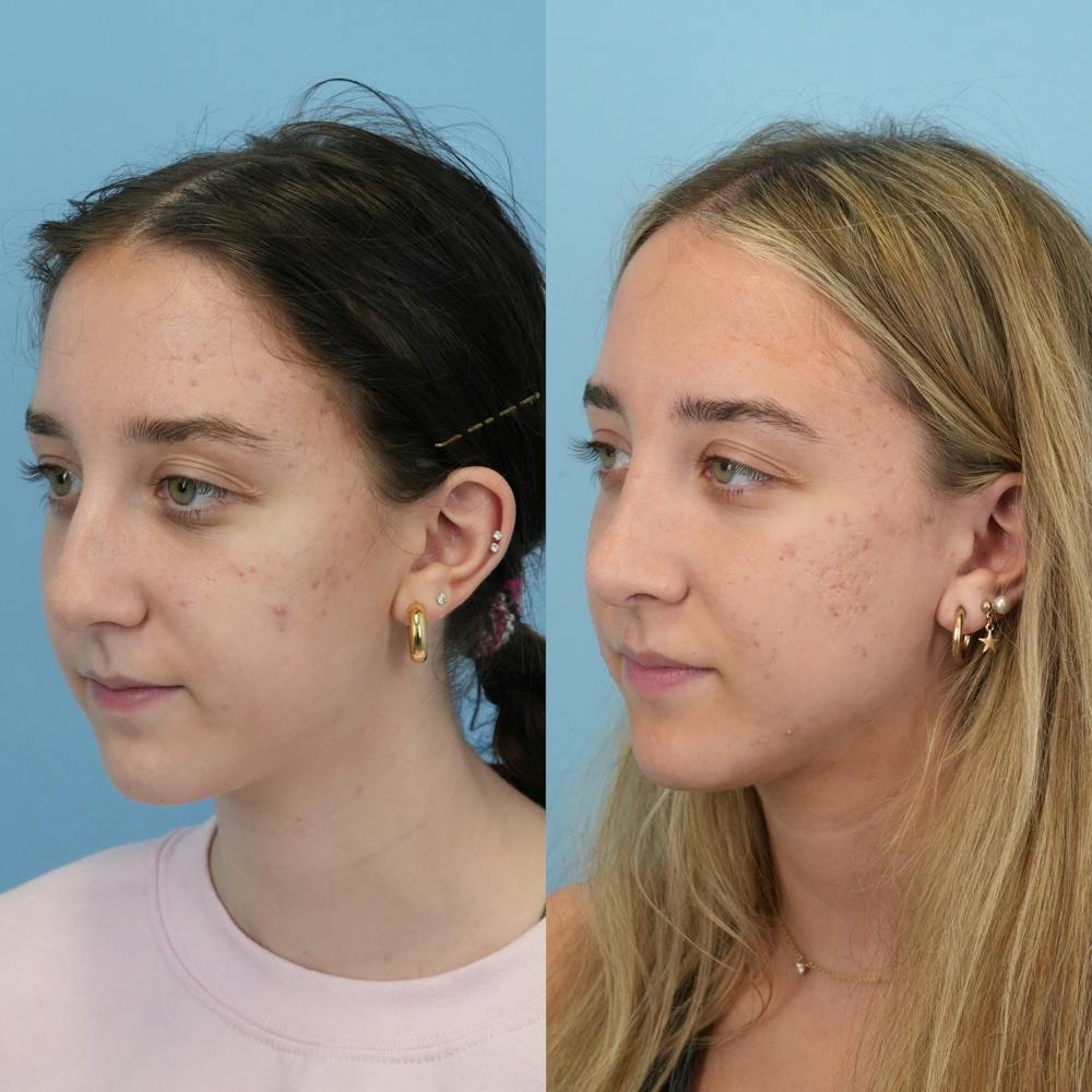 Rhinoplasty Before & After Gallery - Patient 399630 - Image 6