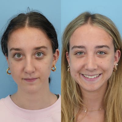 Rhinoplasty Before & After Gallery - Patient 399630 - Image 2