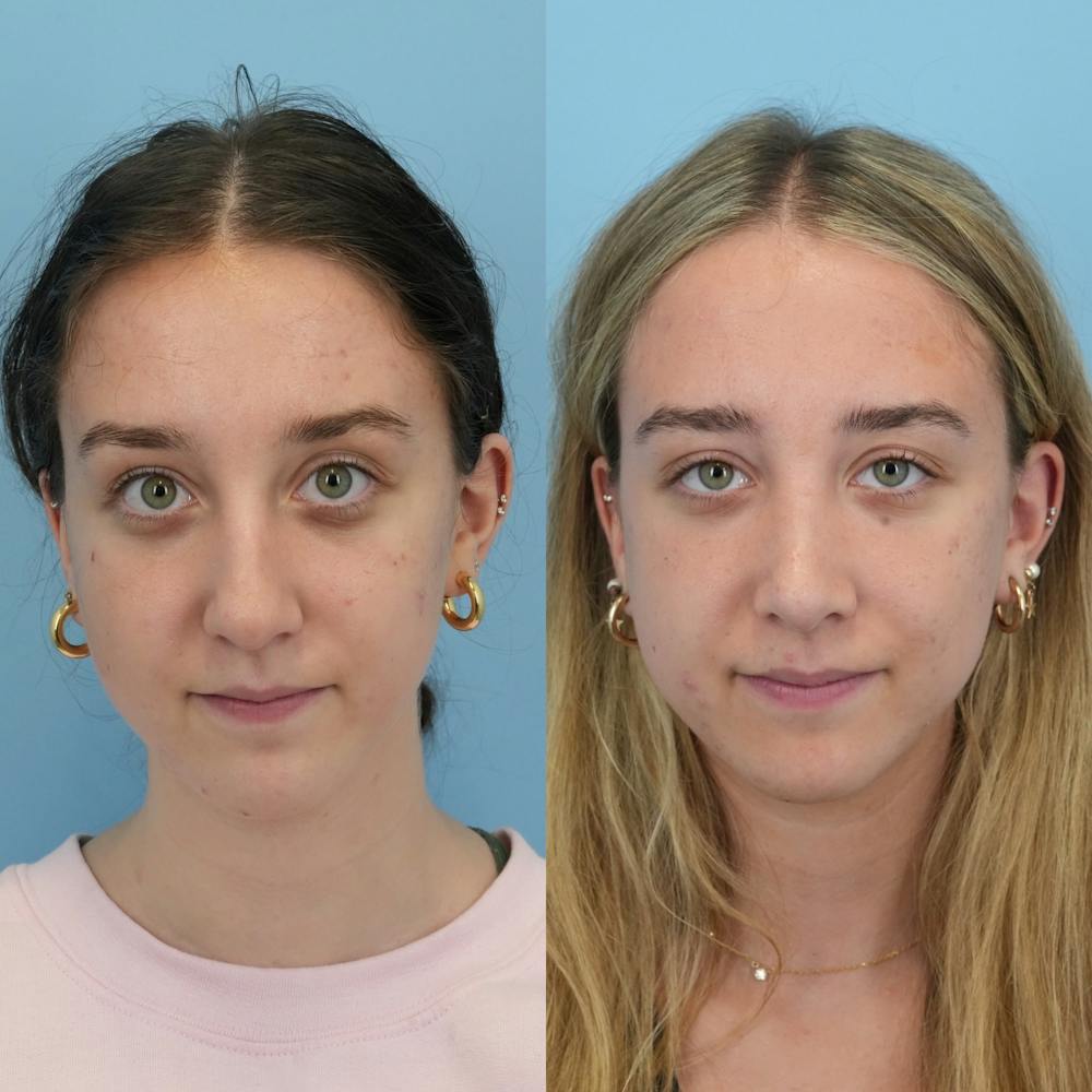 Rhinoplasty Before & After Gallery - Patient 399630 - Image 1