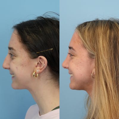Rhinoplasty Before & After Gallery - Patient 399630 - Image 8