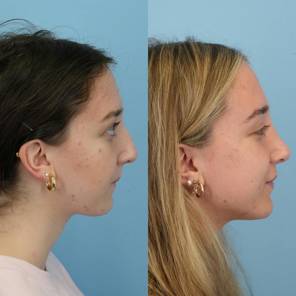 Rhinoplasty Before & After Gallery - Patient 399630 - Image 4